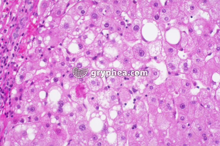 Foie pathologique x100 - gryphea.org